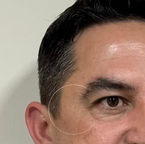Depois: depois do botox, linhas suavizadas