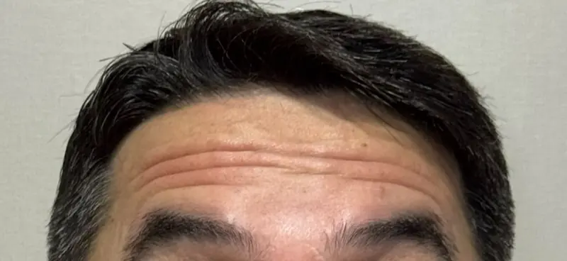 Antes: antes, com rugas na testa