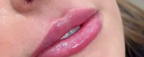 Lábios de paciente depois do preenchimento labial