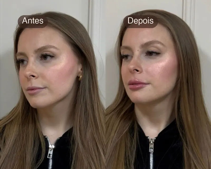 Antes e depois de harmonização orofacial completa, lado a lado