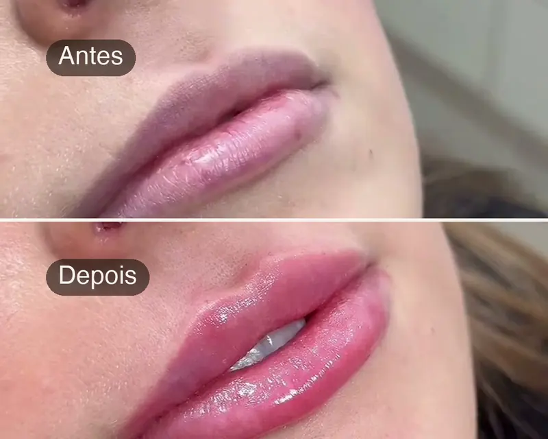 Antes e depois de preenchimento labial