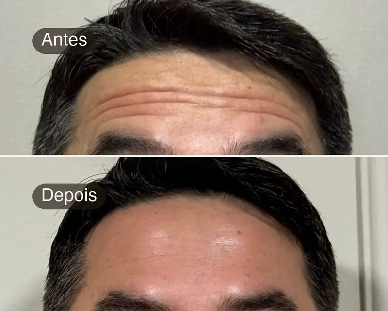 Antes e depois de toxina botulínica na testa de um paciente